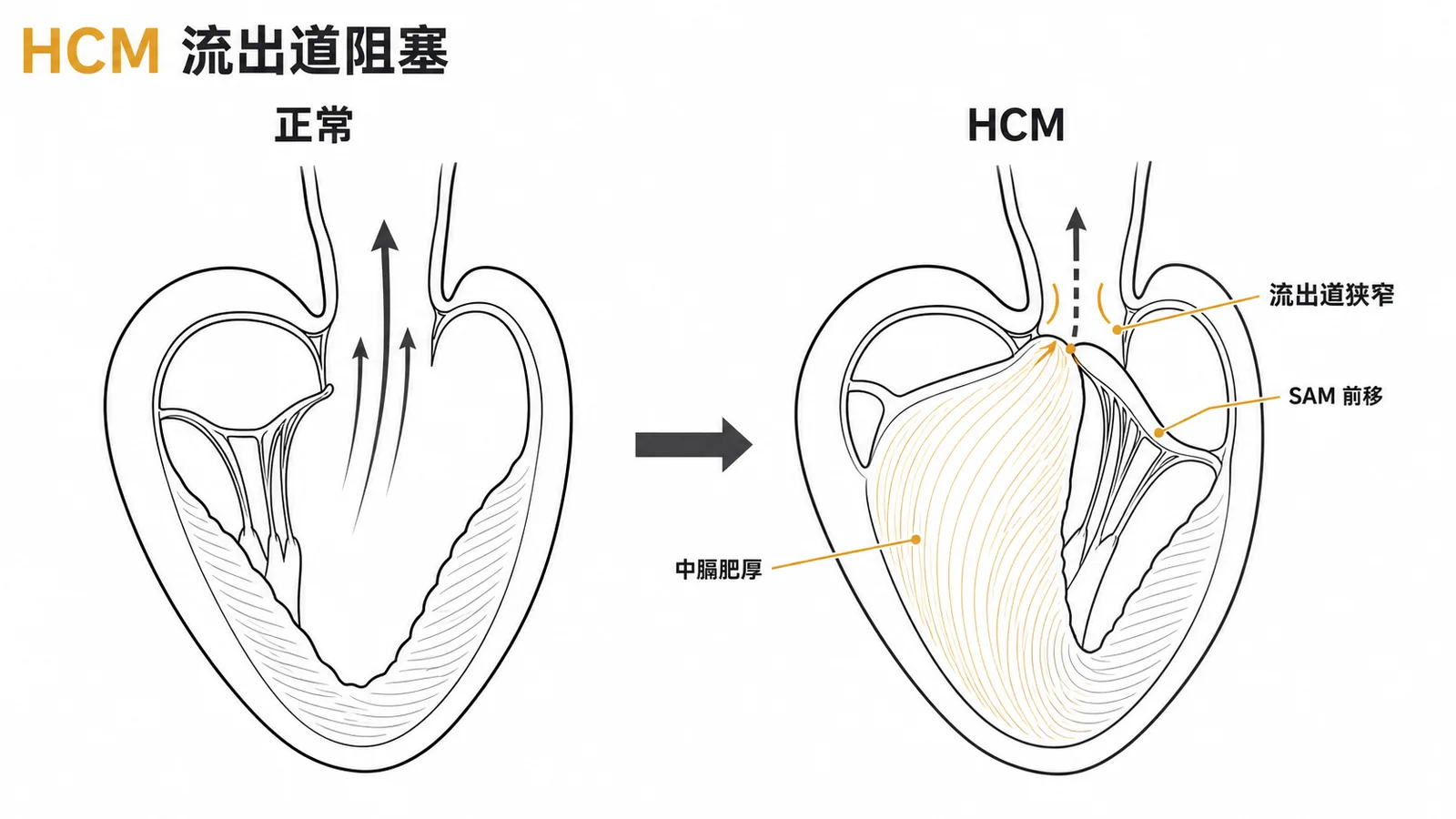 HCM左心室流出道阻塞機制:中膈肥厚與SAM前移