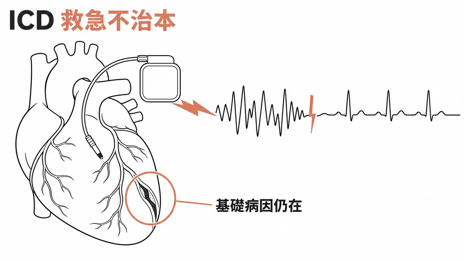 ICD能終止致命心律不整但基礎心臟病仍在
