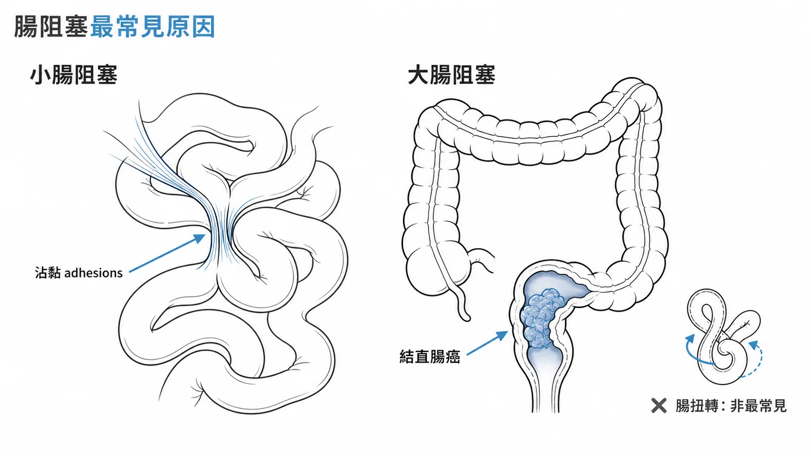 小腸阻塞最常見原因是沾黏、大腸阻塞最常見是結直腸癌