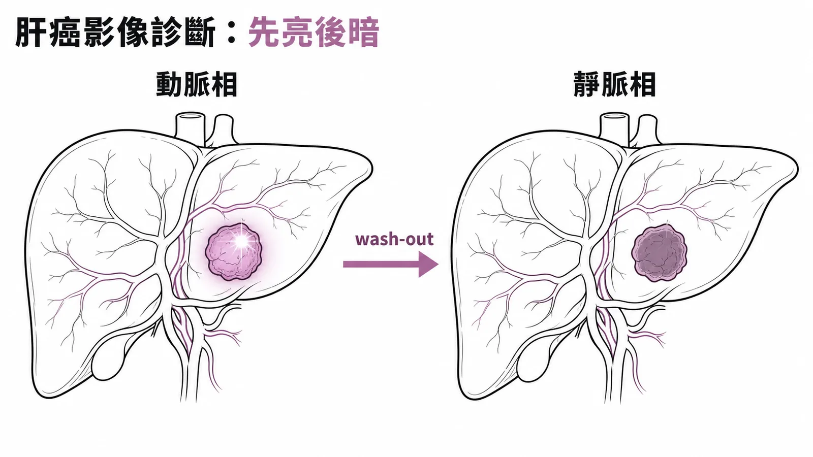 肝細胞癌典型影像:動脈相增強後靜脈相沖失的wash-in wash-out特徵