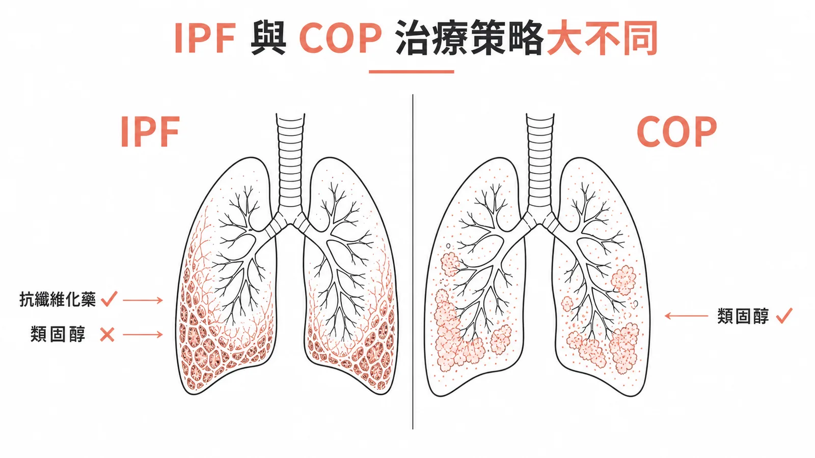 IPF 用抗纖維化藥而非類固醇,COP 則對類固醇反應良好