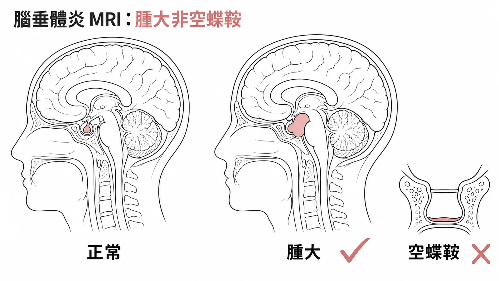 淋巴球性腦垂體炎 MRI 表現為腦垂體腫大,非空蝶鞍