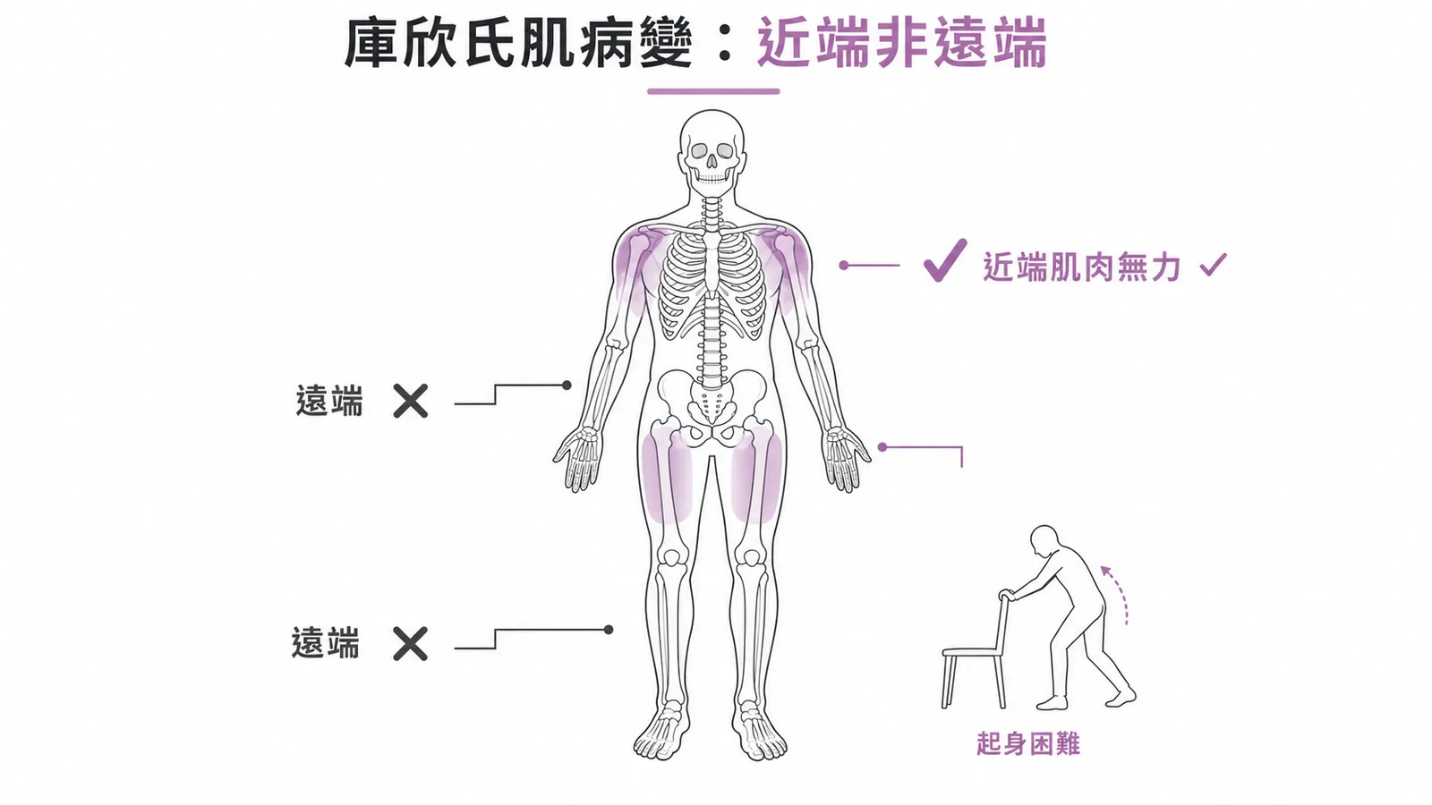 庫欣氏症候群肌病變為近端肌肉無力,非遠端