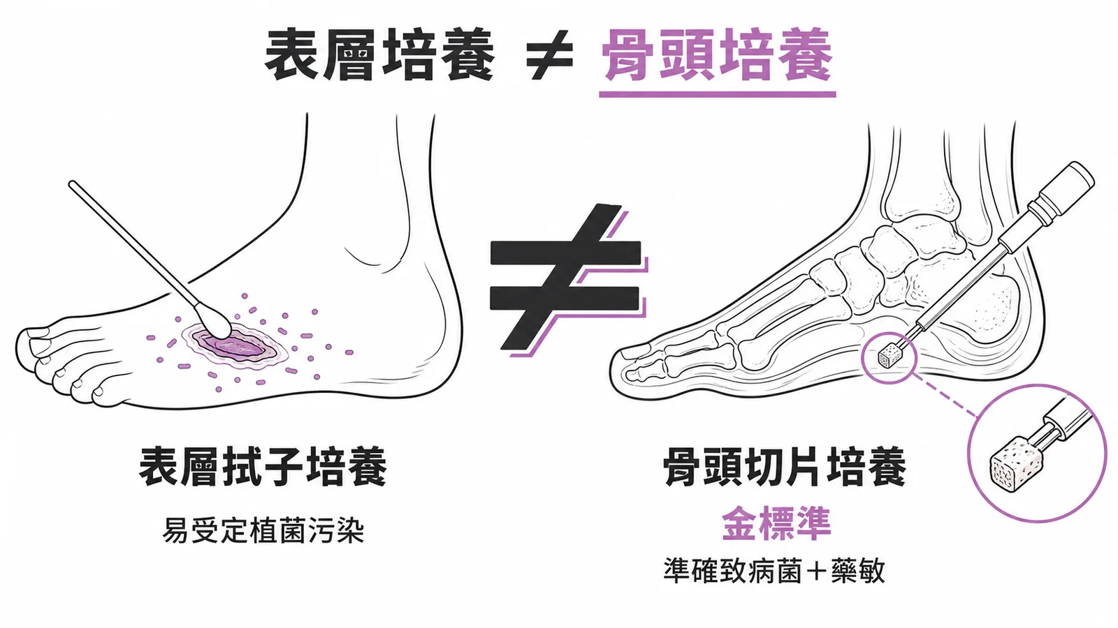 糖尿病足表層拭子培養與骨頭切片培養結果不一致,骨頭切片培養為金標準