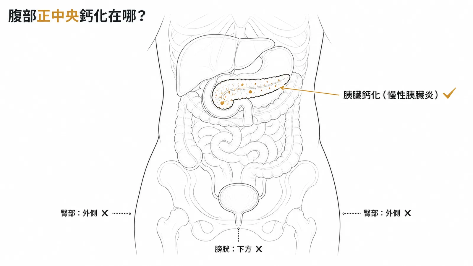 腹部正中央鈣化位置:胰臟位於上腹正中央,慢性胰臟炎為主因
