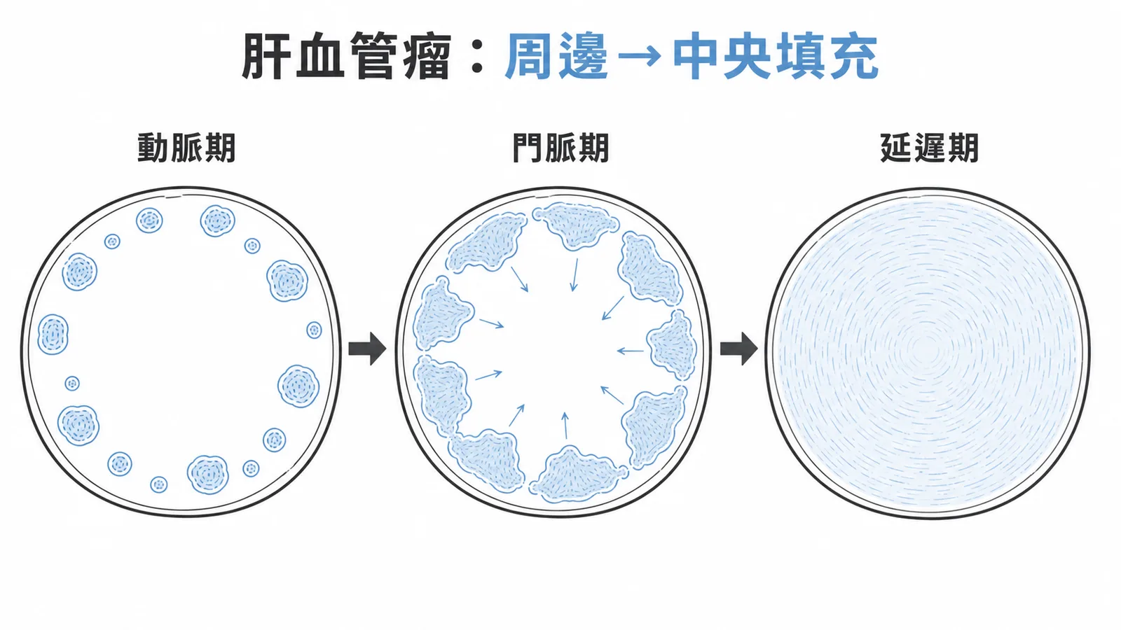 肝血管瘤動態顯影三期:周邊結節狀顯影逐漸向中央填充