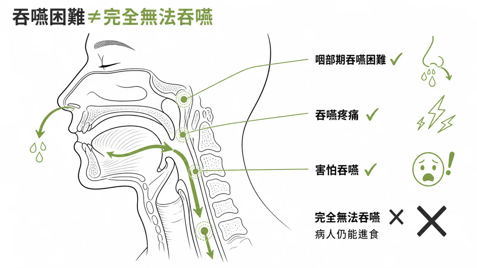 吞嚥困難四種表現對照:aphagia(完全無法吞嚥)不包含在內