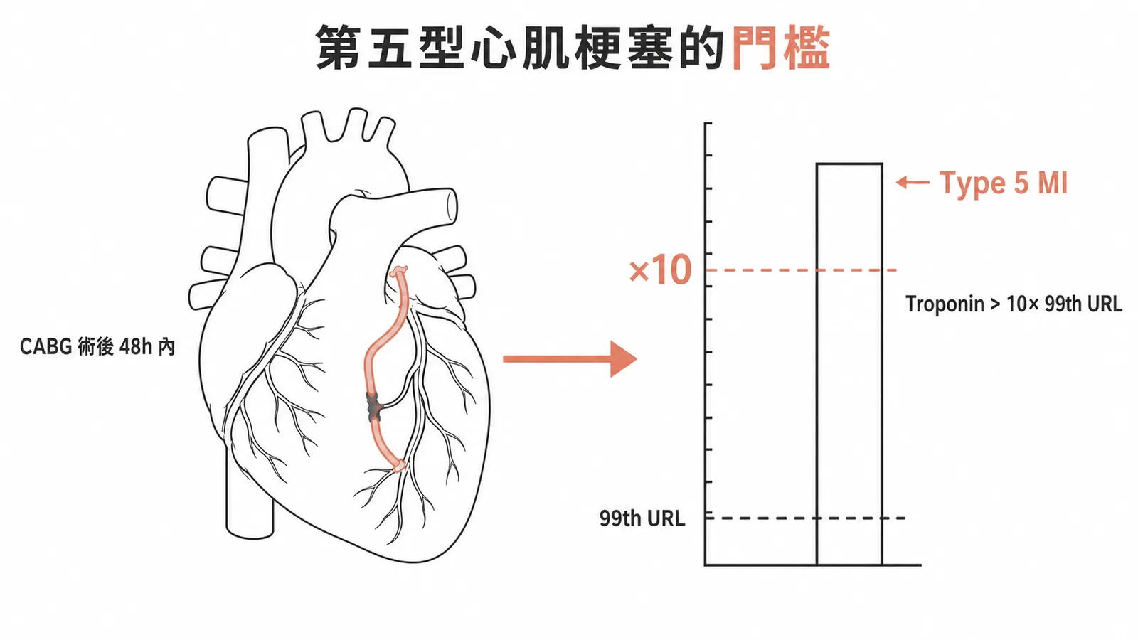 第五型心肌梗塞診斷門檻:CABG術後48小時內troponin超過99百分位上限十倍