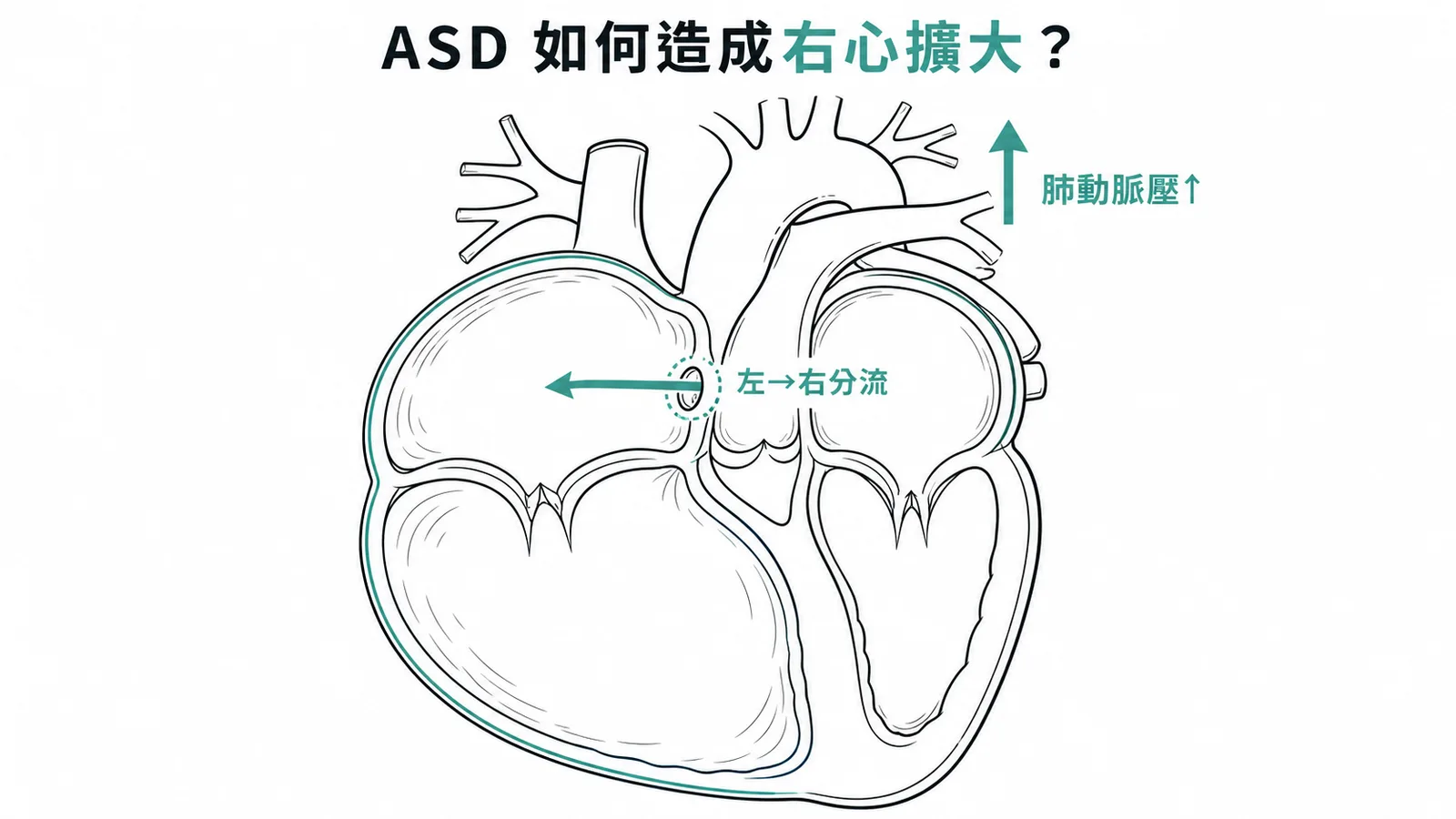 ASD左往右分流導致右心擴大與肺動脈高壓的機轉
