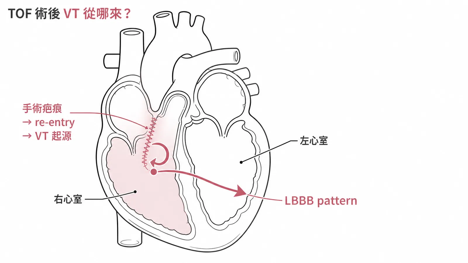 TOF術後VT起源於右心室流出道手術疤痕,LBBB pattern代表右心室起源