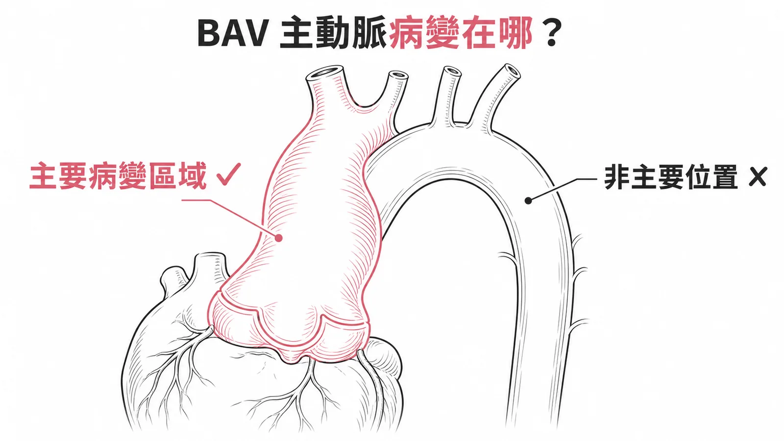 BAV主動脈病變主要發生在主動脈根部與升主動脈,非主動脈弓