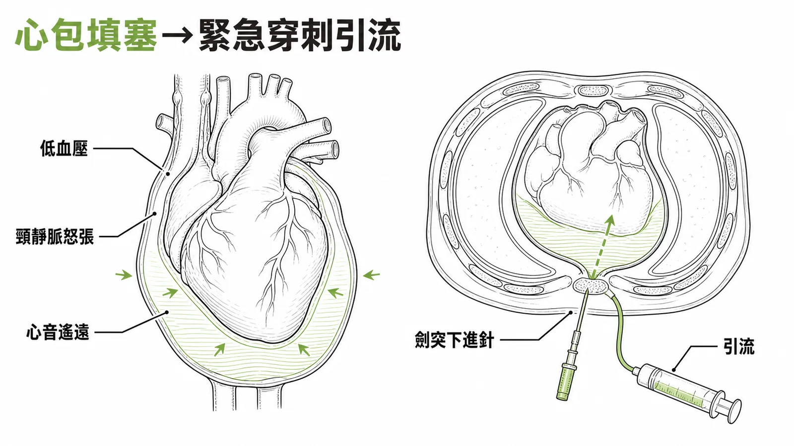 心包填塞 Beck's triad 與緊急穿刺引流示意圖