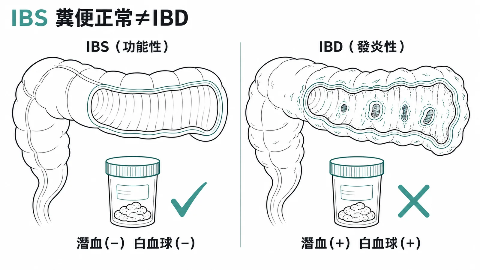IBS 糞便檢查正常與 IBD 對照圖