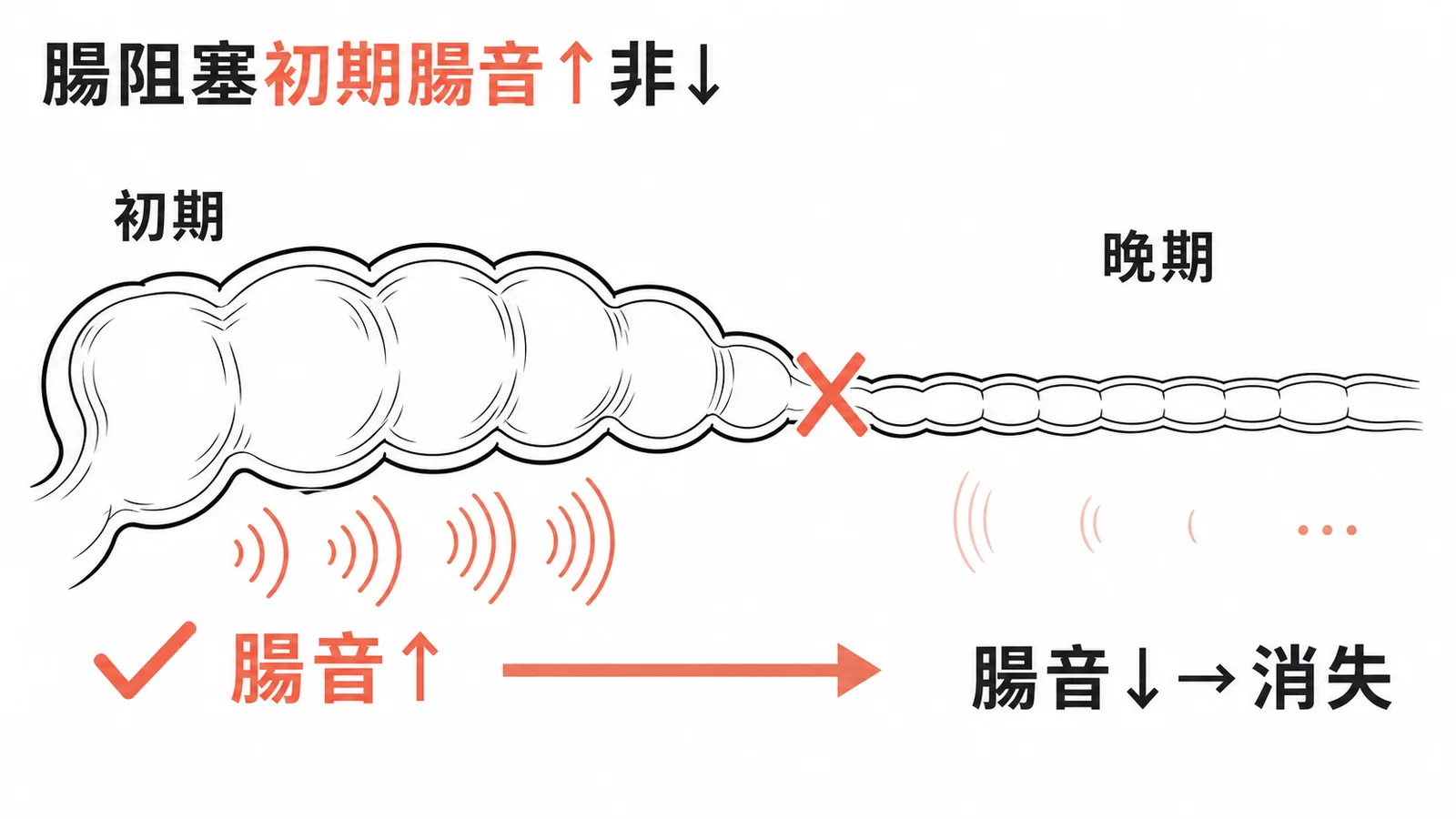 機械性腸阻塞初期腸音活躍高頻的變化過程