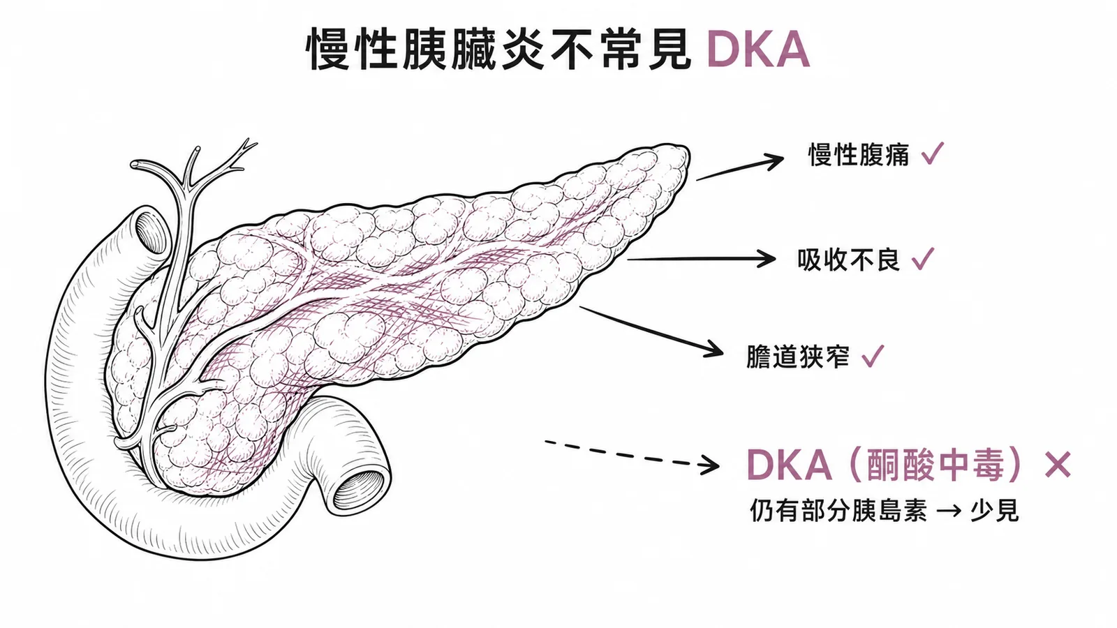 慢性胰臟炎併發症:DKA 不常見