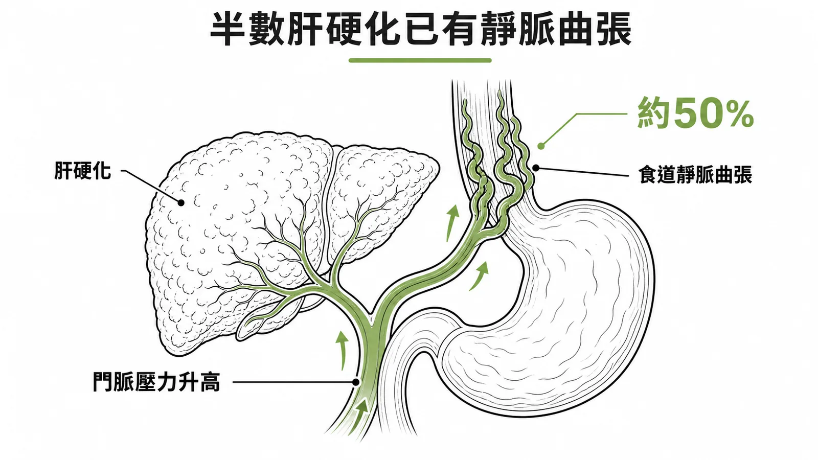肝硬化門脈高壓導致食道靜脈曲張,約50%新診斷即有