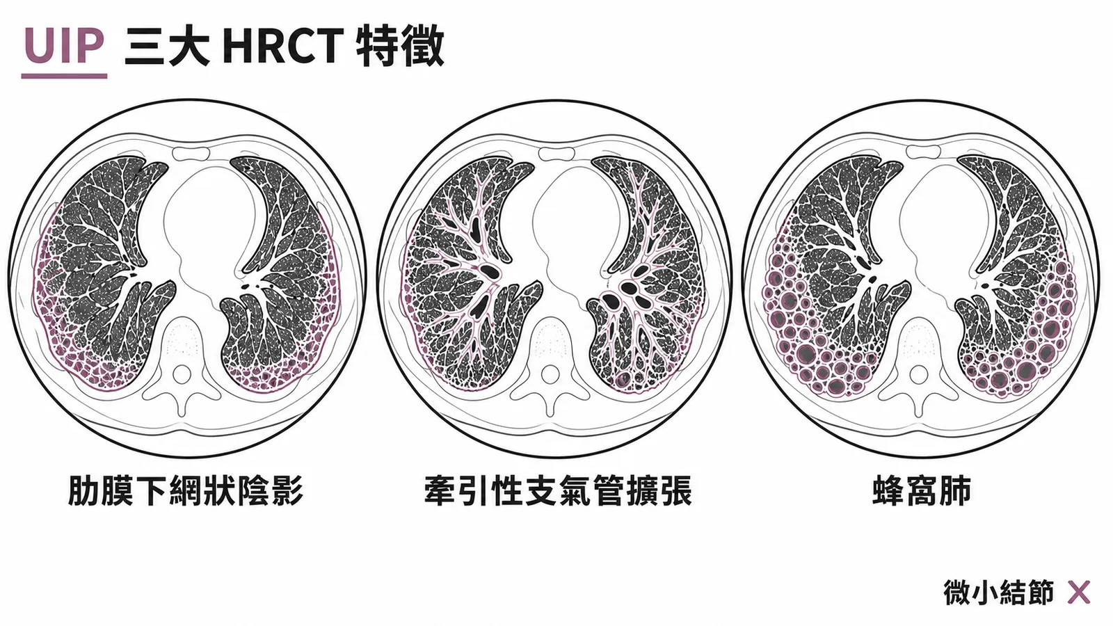 UIP三大HRCT特徵:網狀陰影、牽引性支氣管擴張、蜂窩肺