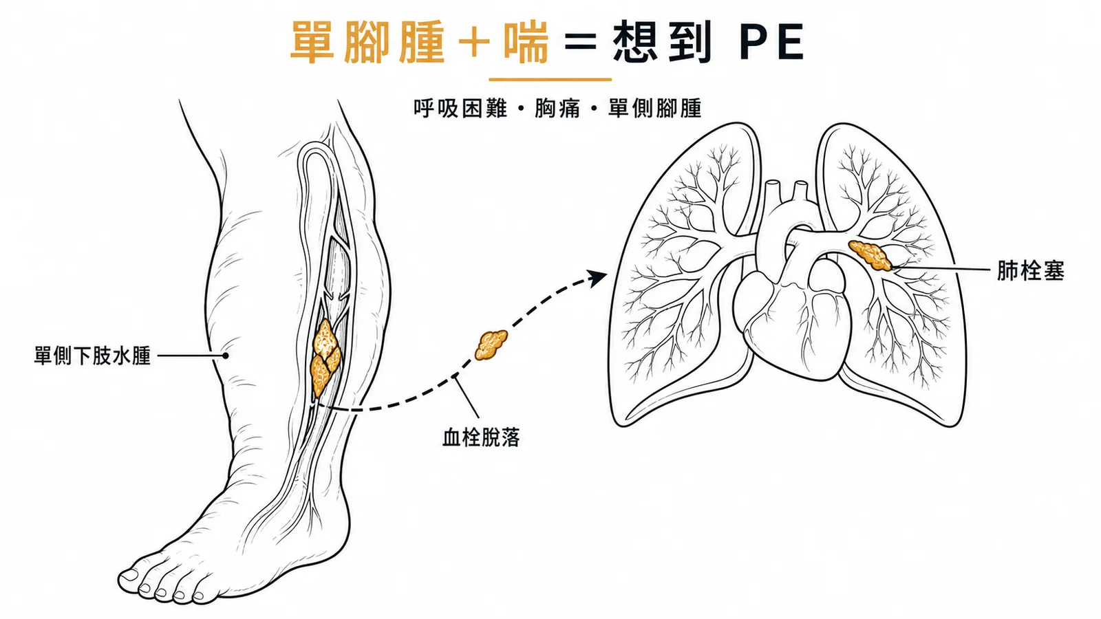 DVT血栓脫落導致肺栓塞的流程示意