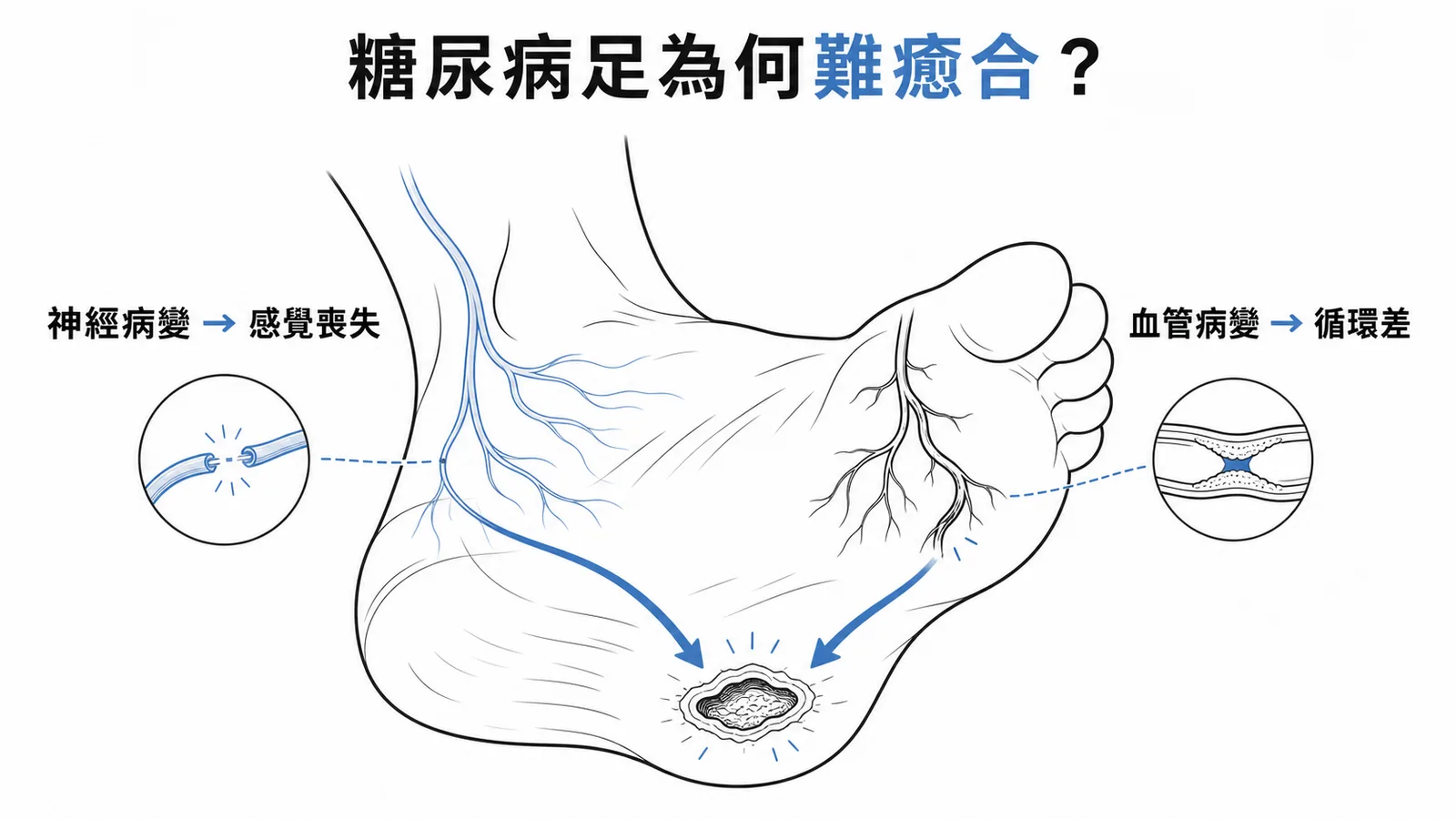 糖尿病足部神經病變與血管病變雙重機制匯聚導致潰瘍的示意圖
