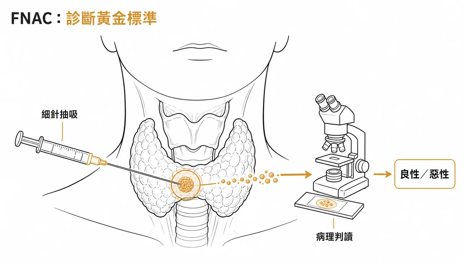 甲狀腺細針穿刺取細胞送病理判讀良惡性的流程示意圖