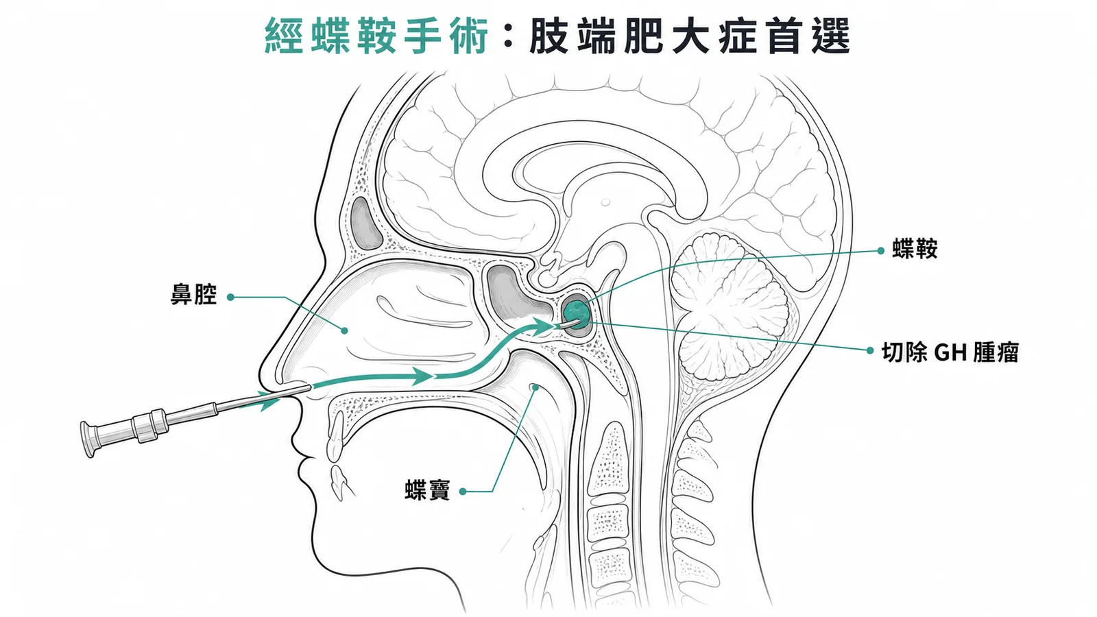 經蝶鞍手術從鼻腔穿過蝶竇到蝶鞍切除腦下垂體 GH 腫瘤的路徑示意圖