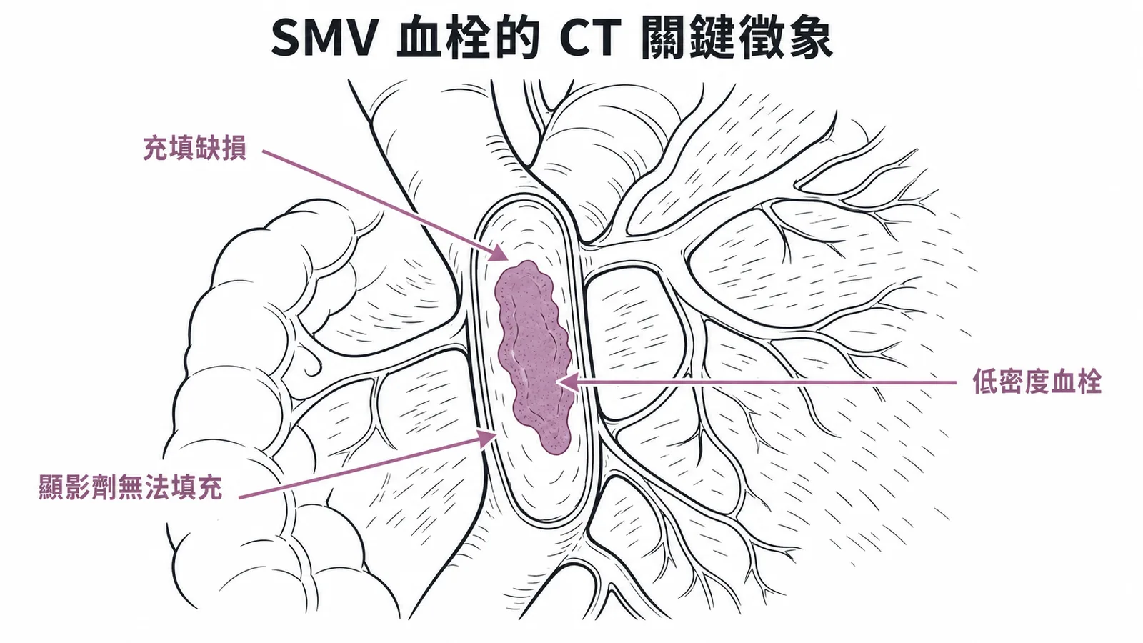 SMV血栓CT關鍵徵象:管腔內低密度充填缺損代表血栓形成