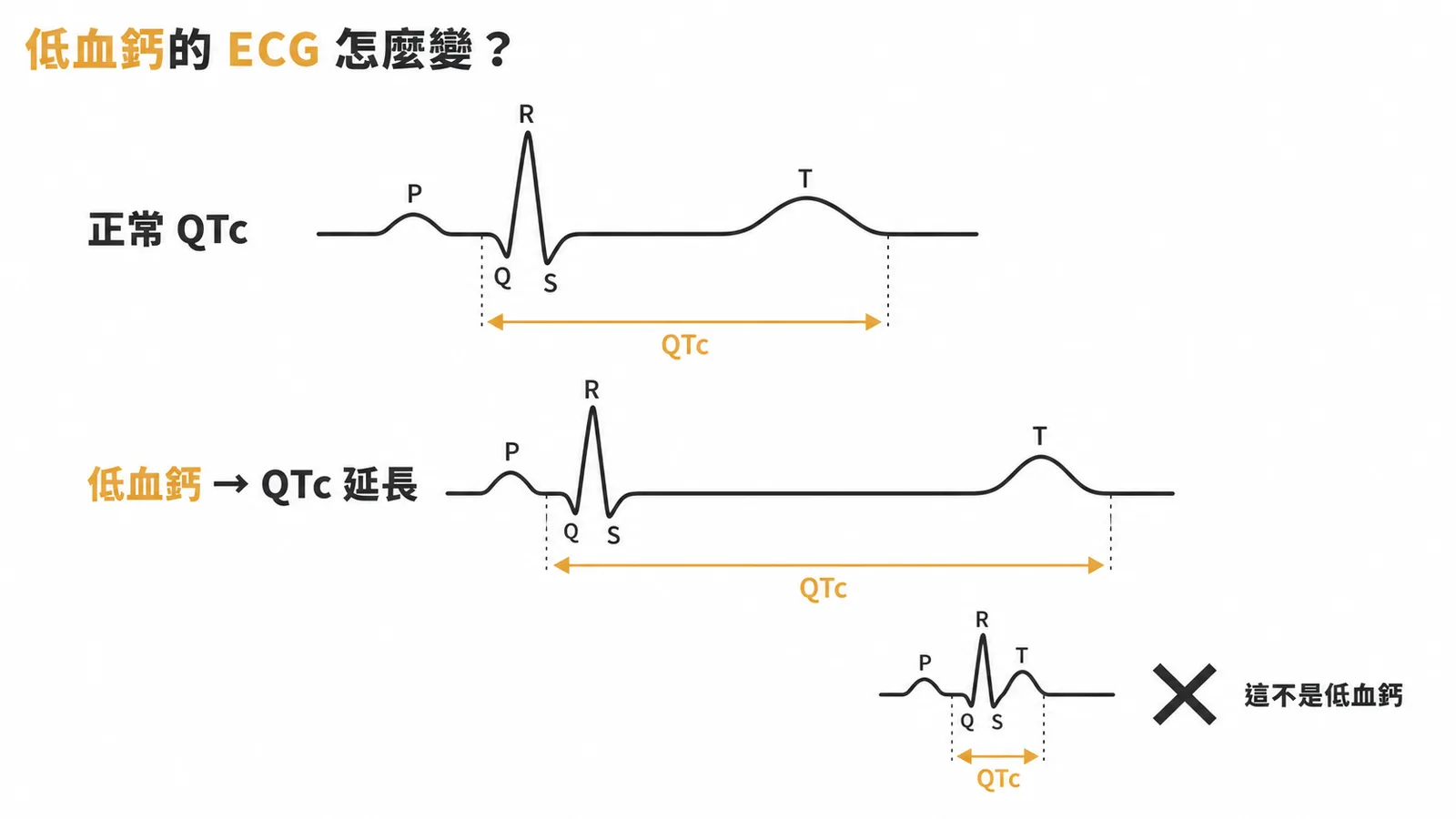 低血鈣ECG變化:QTc延長而非縮短