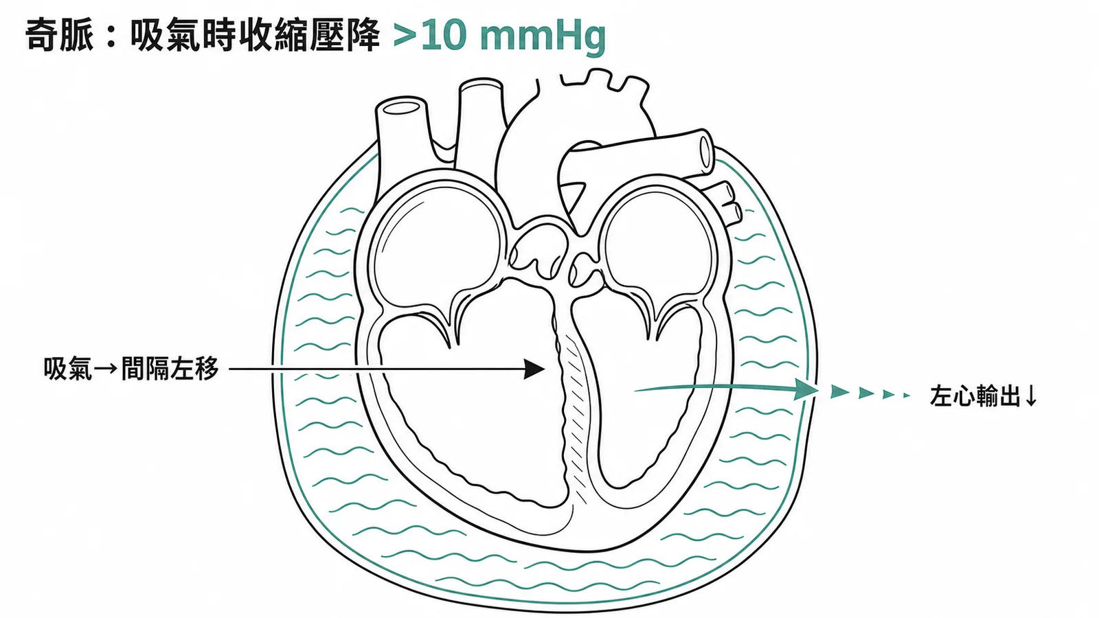 奇脈機制:吸氣時心室間隔左移壓縮左心室輸出