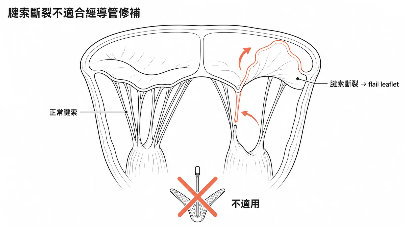 腱索斷裂造成瓣膜脫垂不適合經導管緣對緣修補