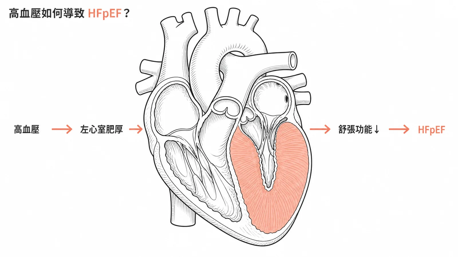 高血壓導致左心室肥厚與舒張功能障礙,形成HFpEF的機轉示意圖