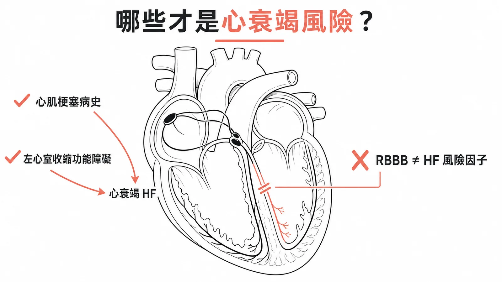 RBBB非獨立心衰竭風險因子,真正風險因子為心肌梗塞病史與左心室收縮功能障礙