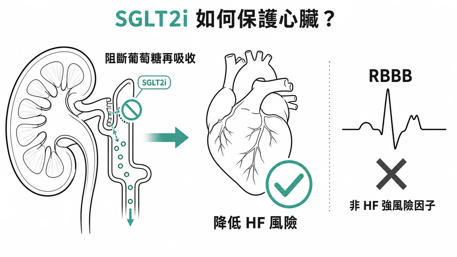 SGLT2i阻斷腎臟葡萄糖再吸收以降低心衰竭風險,RBBB則非獨立HF風險因子