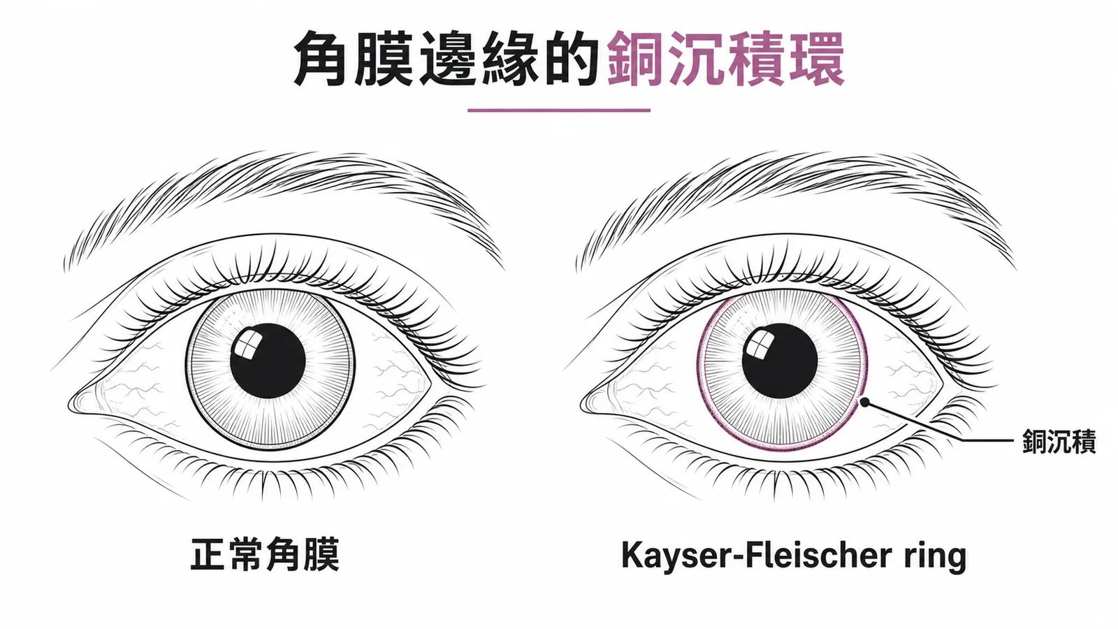 威爾森氏症角膜邊緣Kayser-Fleischer ring銅沉積環與正常角膜對照