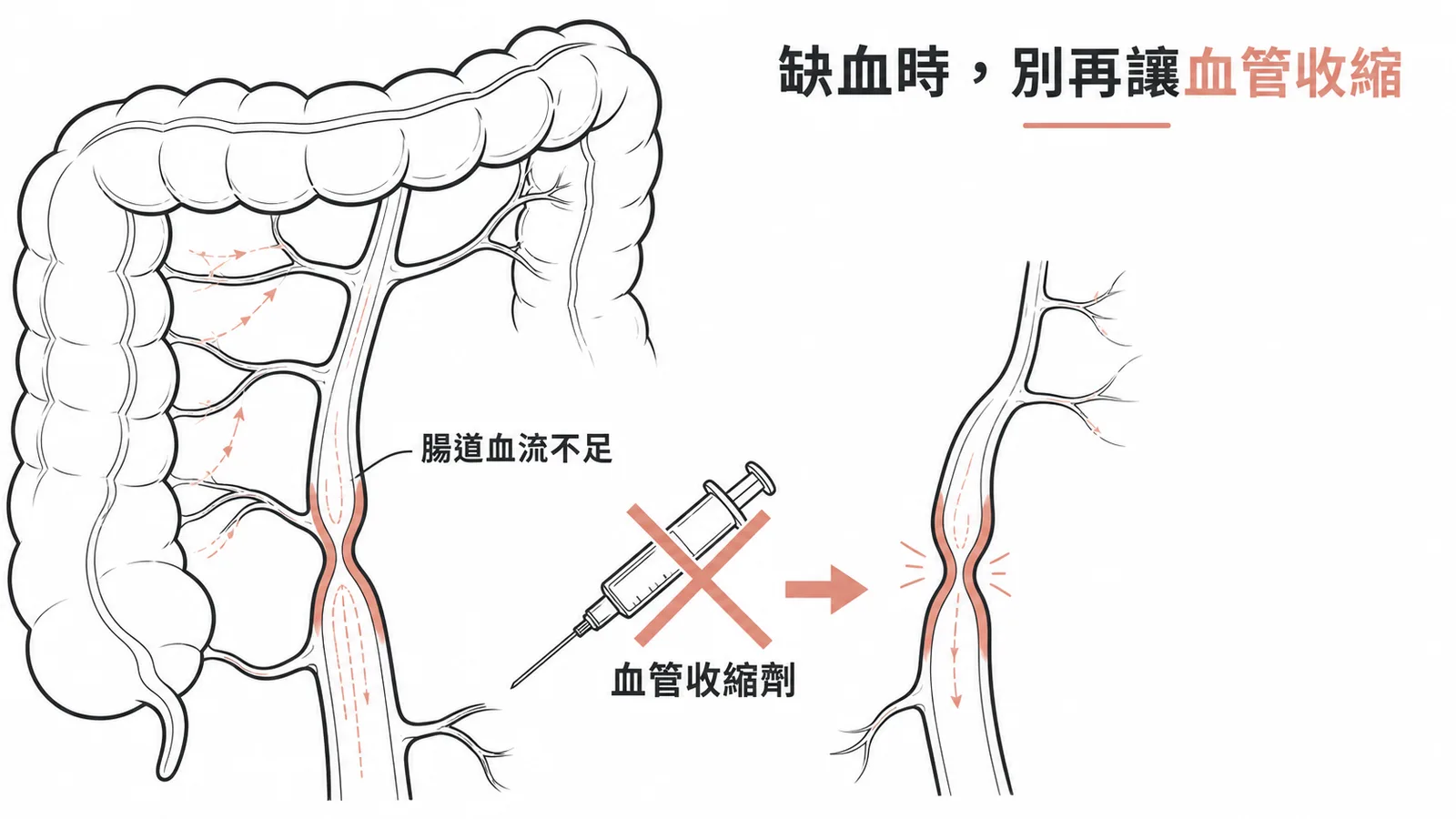 缺血性腸炎禁用血管收縮劑,因腸道血流已不足時收縮劑會加重缺血