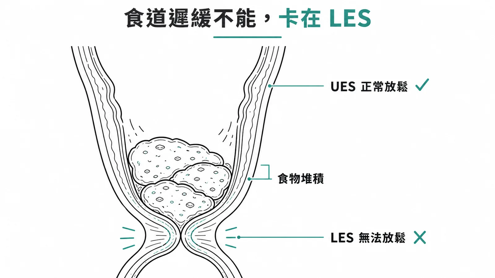 食道遲緩不能是LES無法放鬆導致食物堆積,UES功能正常