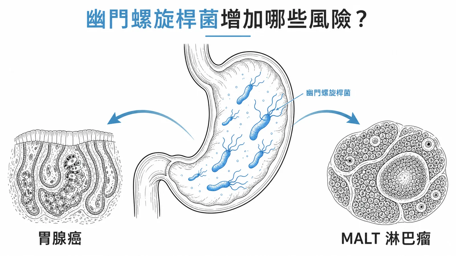 幽門螺旋桿菌感染增加胃腺癌與MALT淋巴瘤風險示意圖