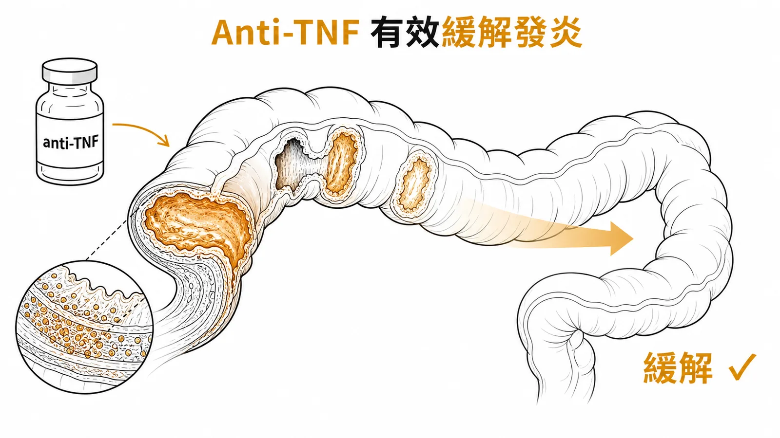 Anti-TNF製劑有效緩解中重度克隆氏病腸道發炎示意圖