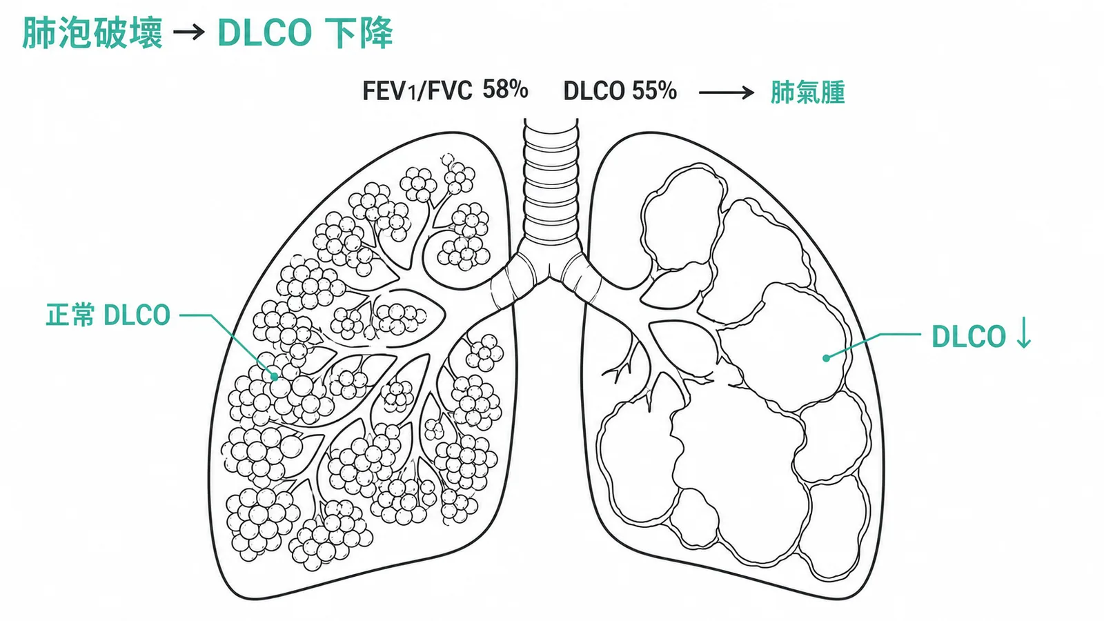 肺氣腫肺泡破壞導致DLCO下降的肺功能特徵