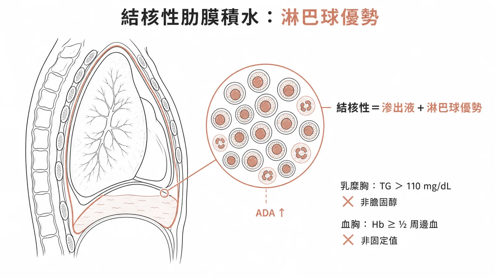 結核性肋膜積水淋巴球優勢特徵與乳糜胸血胸鑑別
