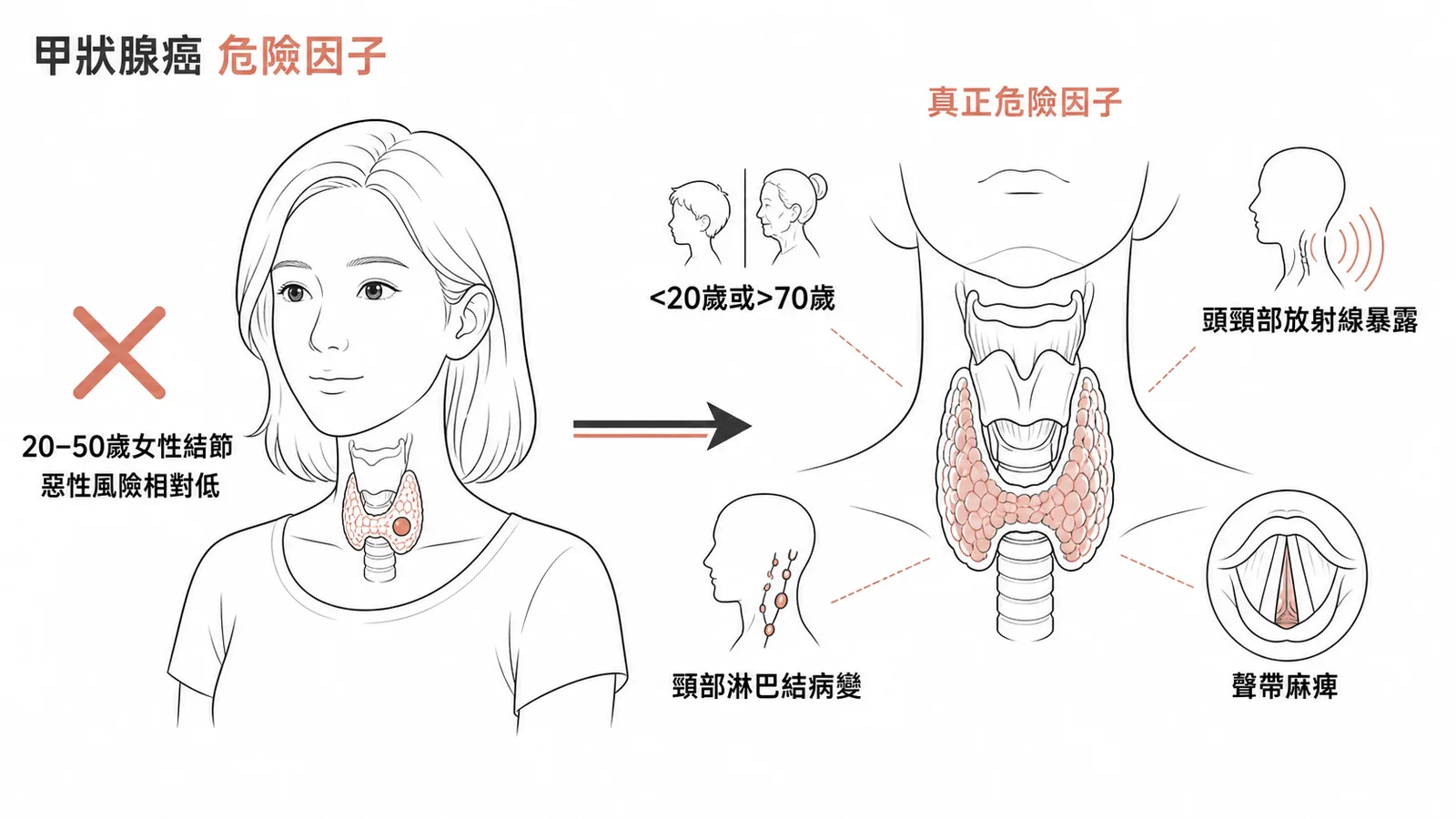甲狀腺癌危險因子:20-50歲女性結節惡性風險相對低,真正危險因子為極端年齡、放射線暴露、頸部淋巴結病變及聲帶麻痺