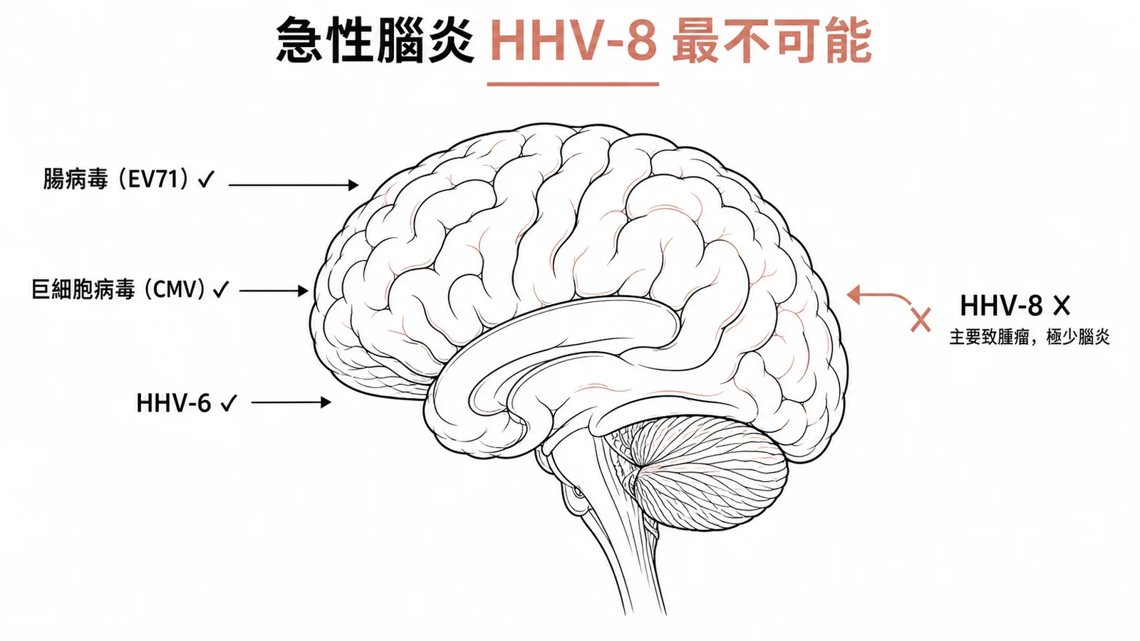 急性腦炎常見病毒:腸病毒、CMV、HHV-6 皆可致腦炎,HHV-8 主要致腫瘤最不可能