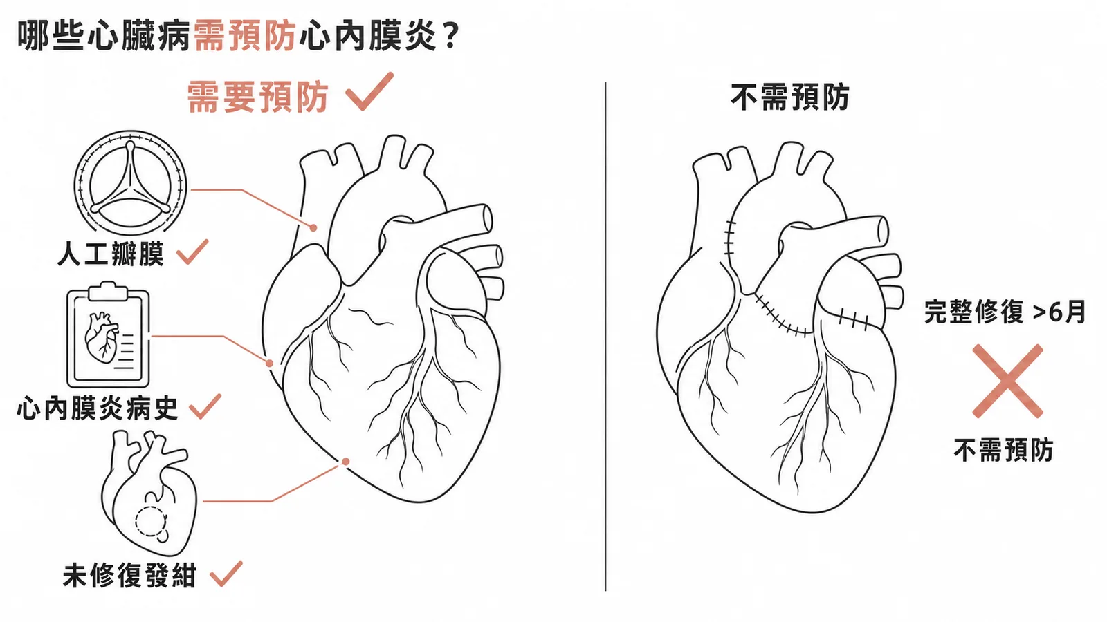 心內膜炎預防性抗生素適應症:人工瓣膜、心內膜炎病史、未修復發紺需預防,完整修復逾六個月不需預防