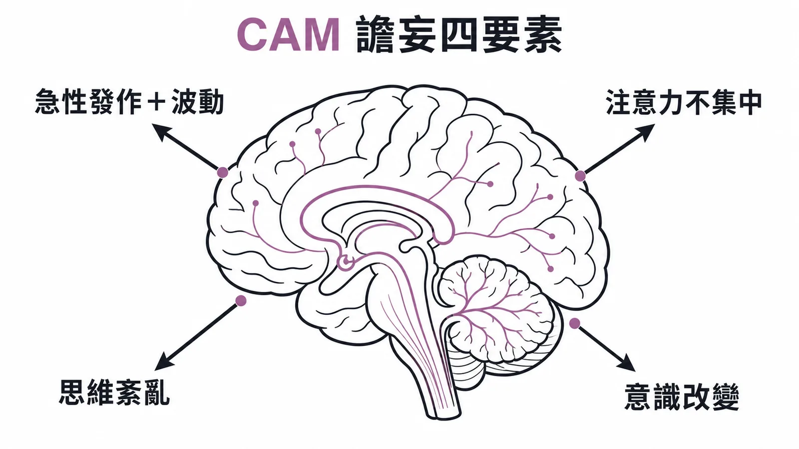 CAM 譫妄診斷四要素:急性發作波動、注意力不集中、思維紊亂、意識改變