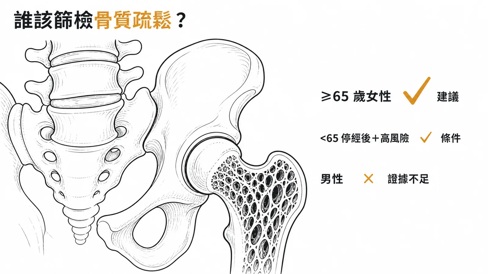 USPSTF 骨質疏鬆篩檢建議:65 歲以上女性明確建議,男性證據不足