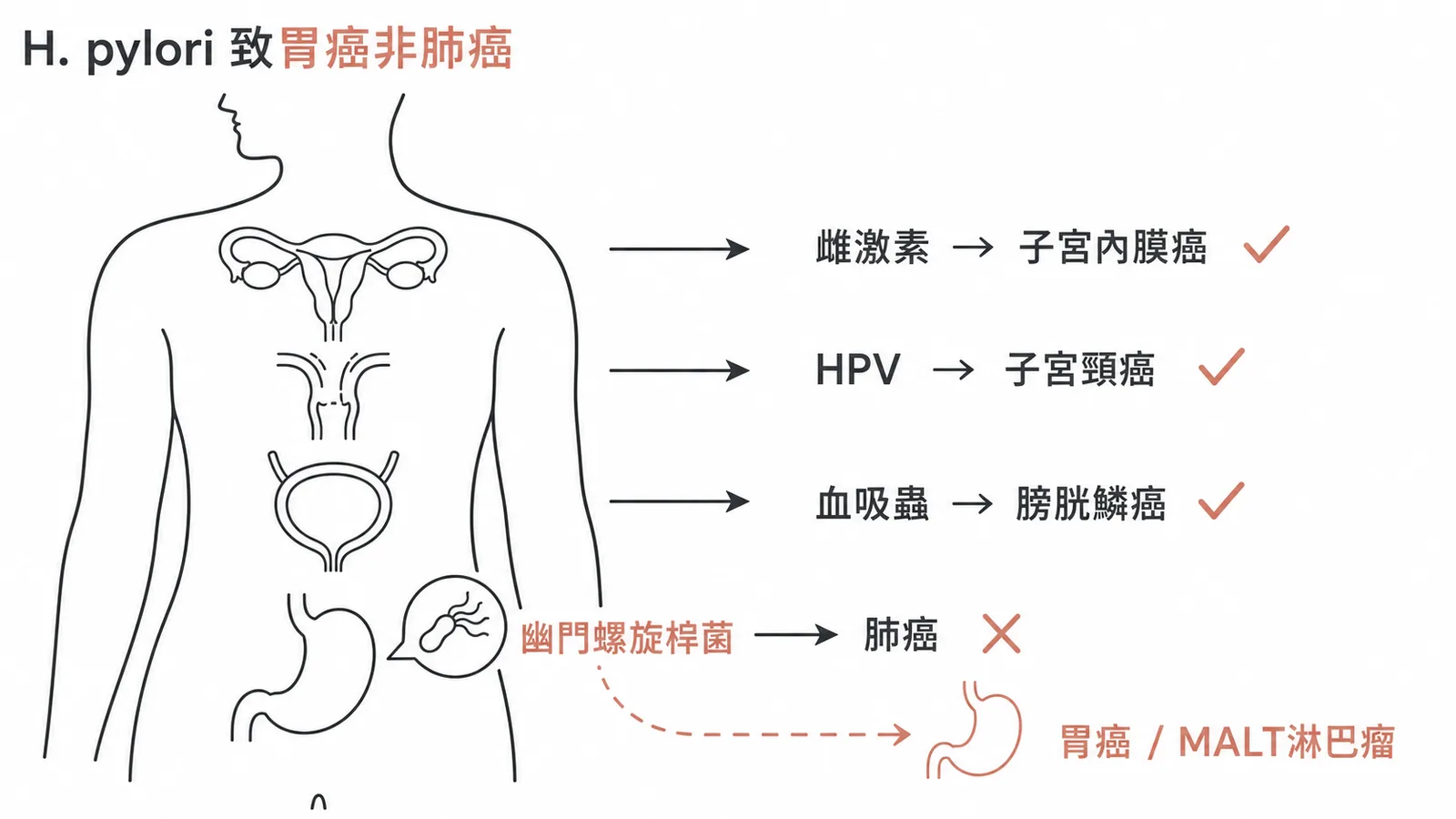 致癌因子與對應癌症配對：H. pylori致胃癌非肺癌