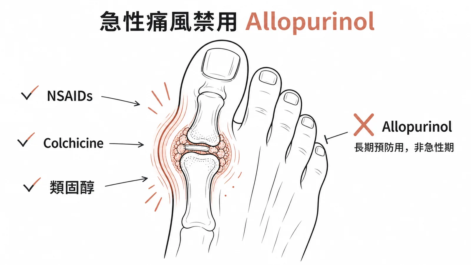 急性痛風適用NSAIDs、colchicine、類固醇；allopurinol為長期預防用藥不可急性期使用