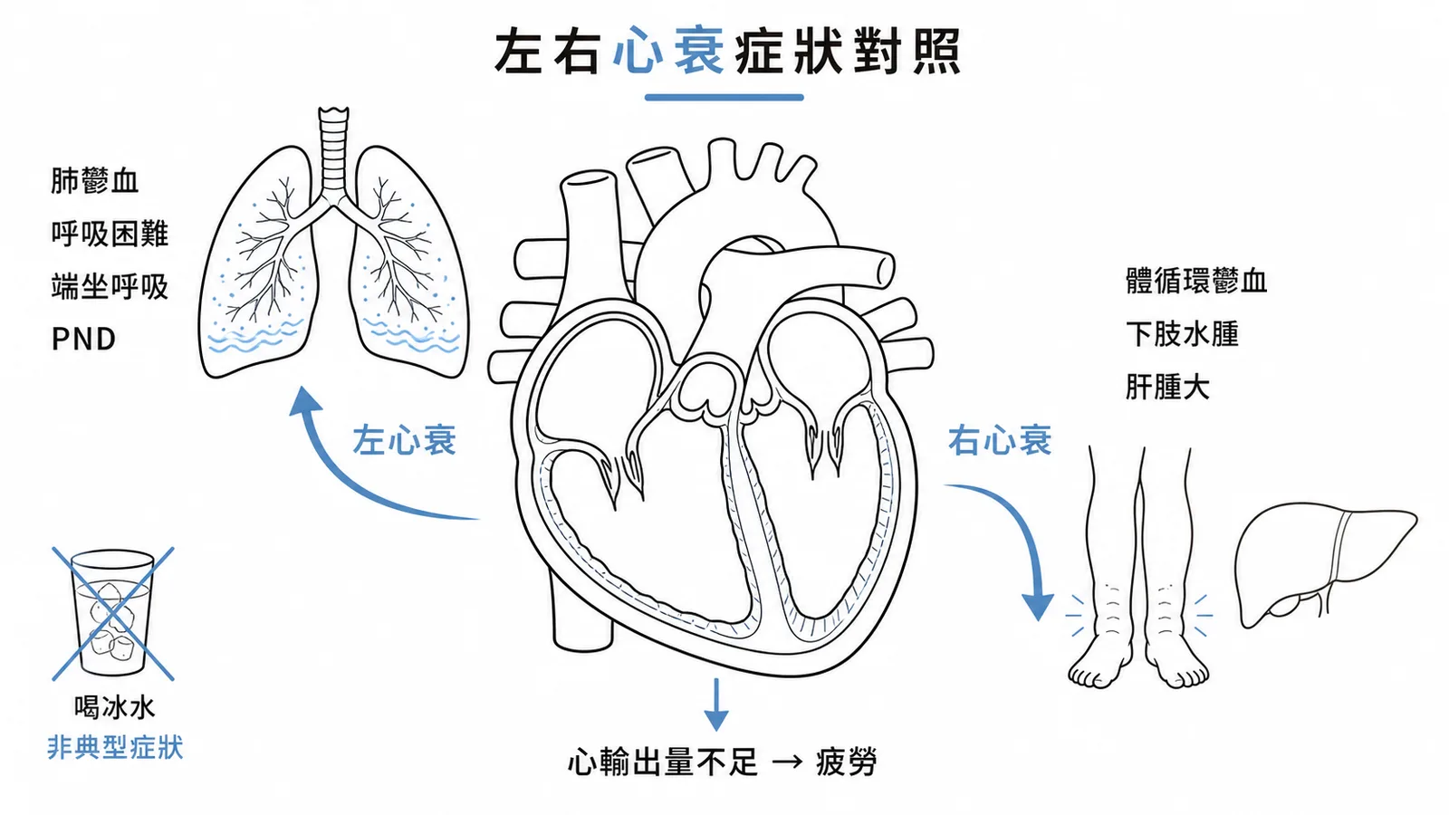 左右心衰症狀對照：左心衰致肺鬱血（呼吸困難、PND），右心衰致體循環鬱血（下肢水腫、肝腫大），喝冰水非臨床症狀