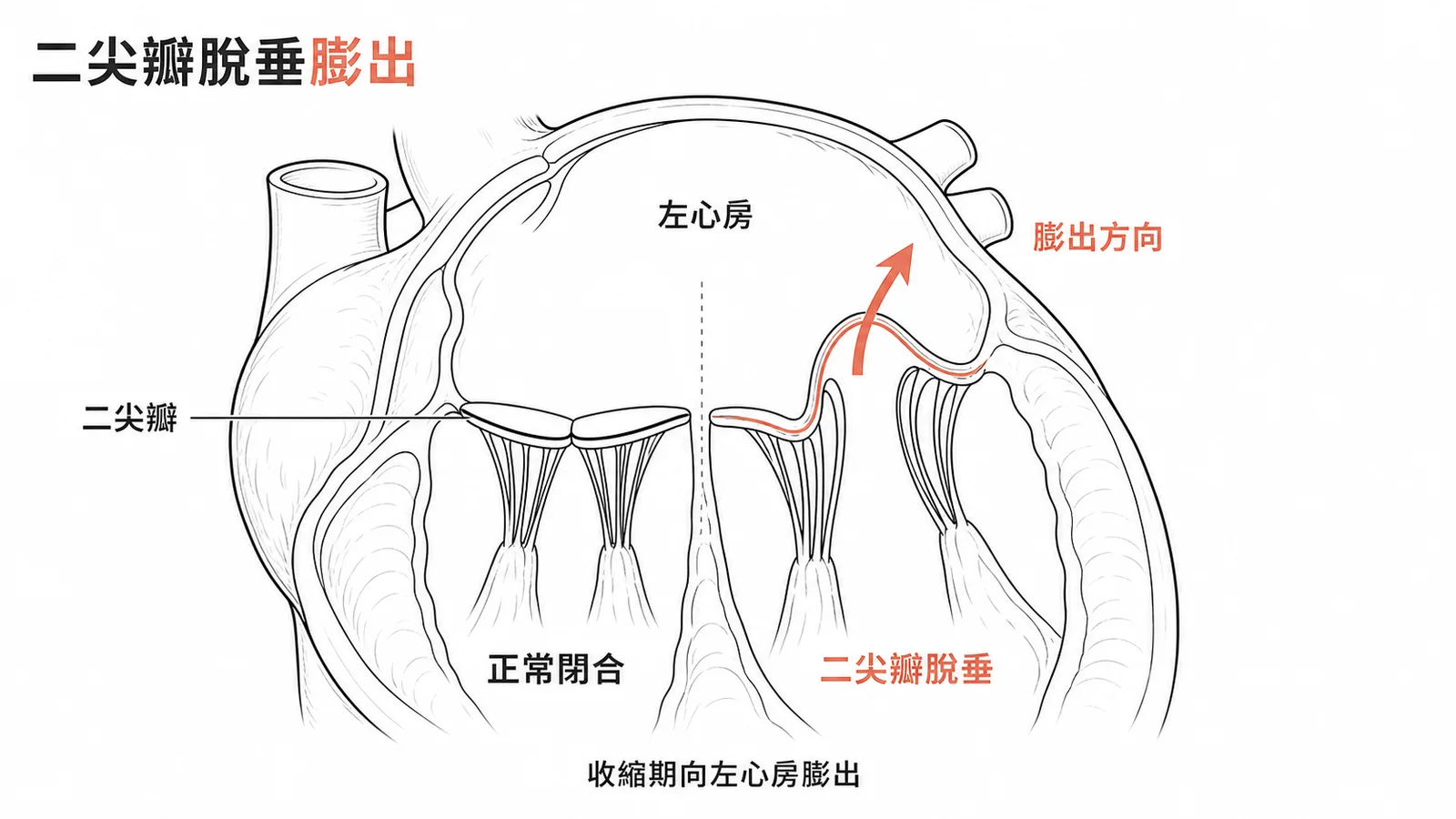 二尖瓣脫垂：瓣葉在收縮期向左心房膨出，黏液性變性所致