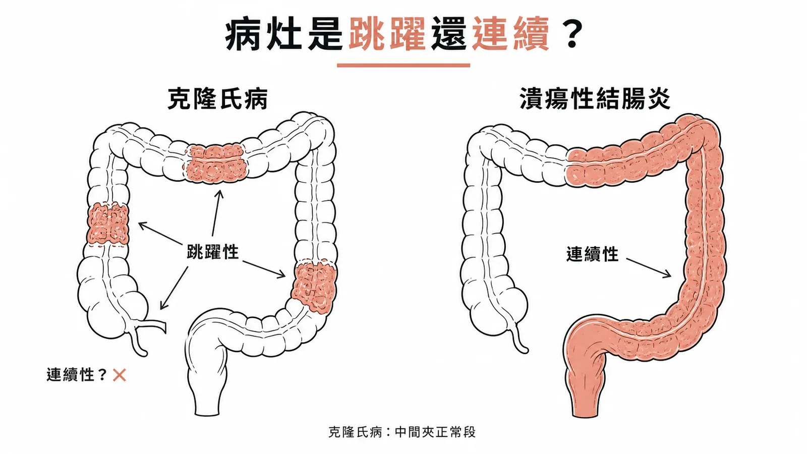 克隆氏病跳躍性病灶與潰瘍性結腸炎連續性病灶的腸道對比示意圖