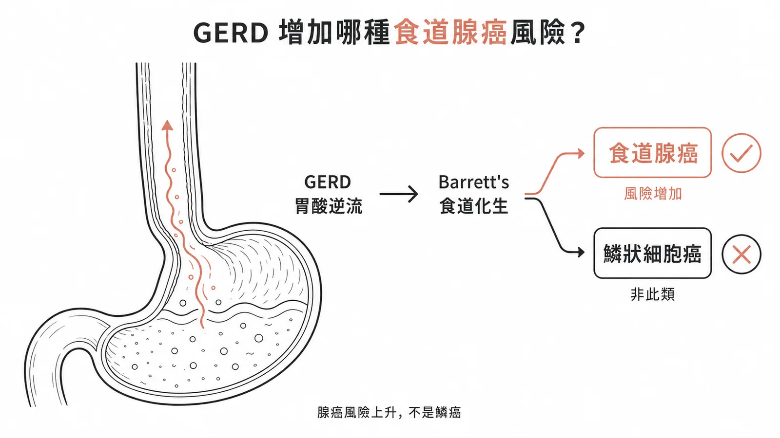 GERD經Barrett's食道化生增加食道腺癌而非鱗狀細胞癌風險的流程示意圖
